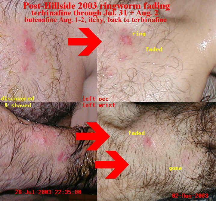 Fading of ringworm lesions after Hillside 2003 
using terbinafine and butenafine treatment
